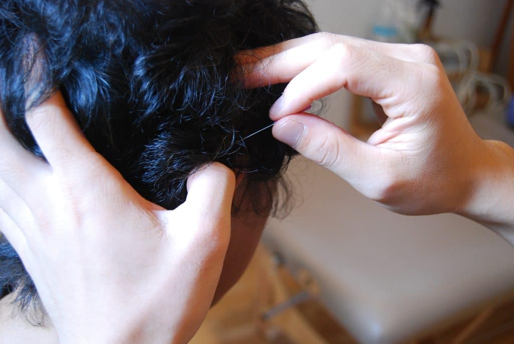 YNSA山元式新頭鍼療法