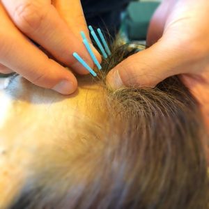 YNSA山元式新頭療法